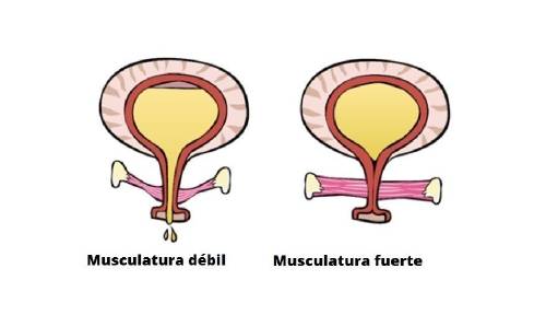 incontinencia urinaria